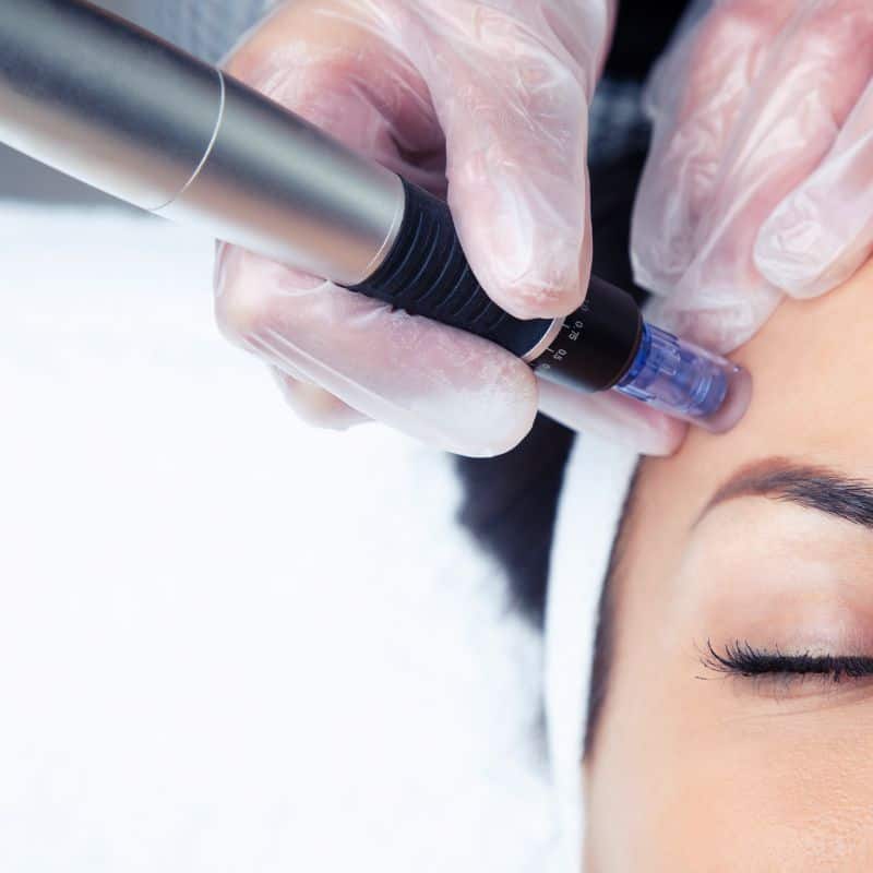 Morpheus8 treatment Oadby from Lipo Sculpt - Book in today!